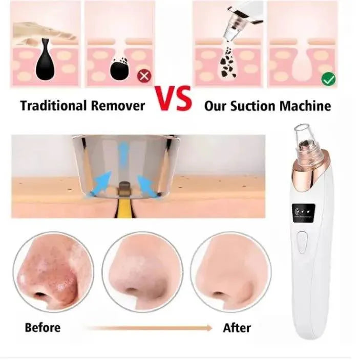 5 in 1 Electric Rechargeable Black Head Remover Machine
